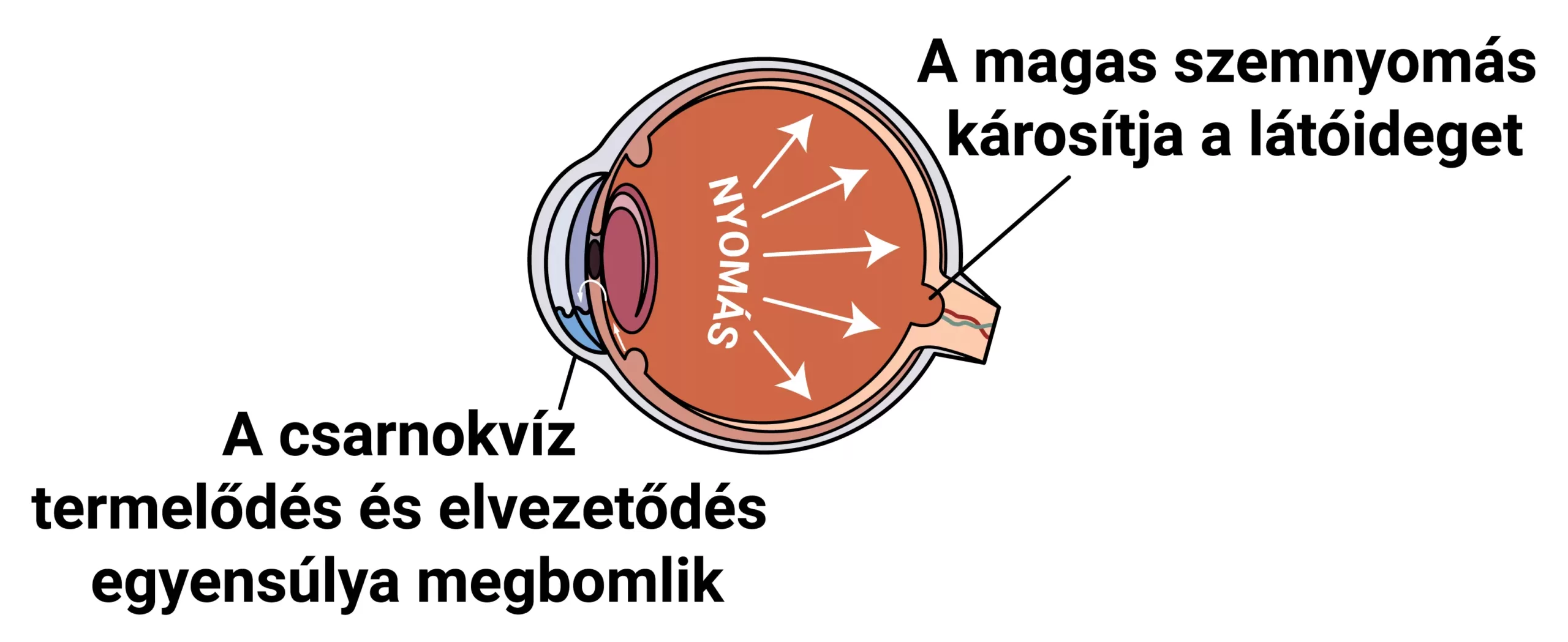 Budai Szemészeti Központ | zöldhályog, glaukóma, látóideg