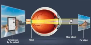 Asztigmia, a szem működése, lézeres látásjavítás