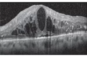 Diabéteszes makula ödéma - Diabéteszes retinopátia - OCT kép