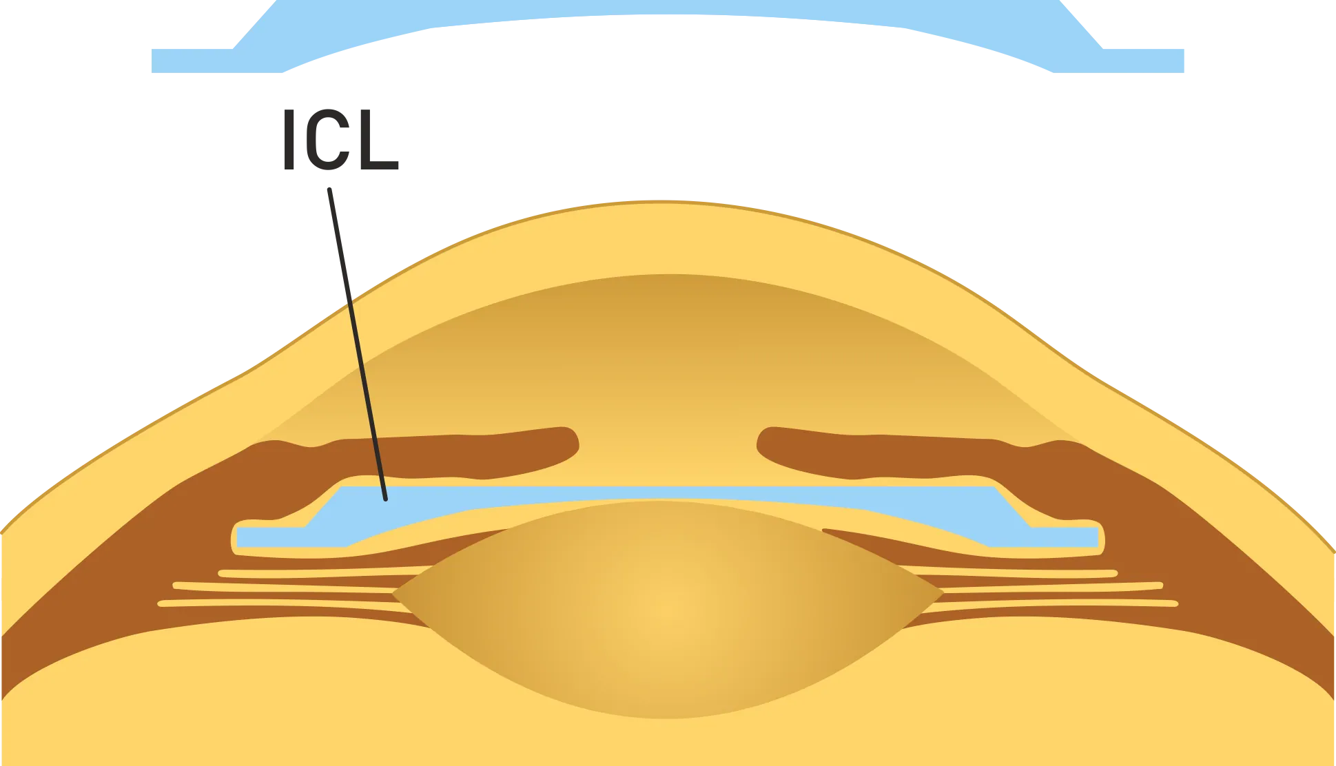 ICL, látásjavítás, vékony szaruhártya, szemen belüli kontaktlencse, Implantable Collamer Lens elhelyezkedés