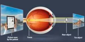 Rövidlátás, a szem működése, lézeres látásjavítás