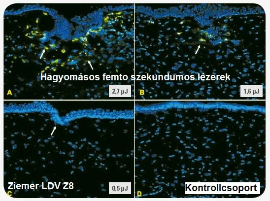 Ziemer Femto LDV Z8, lézeres szemműtét, kíméletes lézeres kezelés